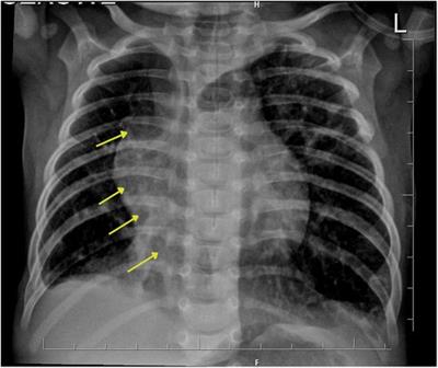 Case report: A unique quadruple coexisting anomaly—scimitar syndrome, atrial septal defect, vascular ring, and pulmonary sequestration